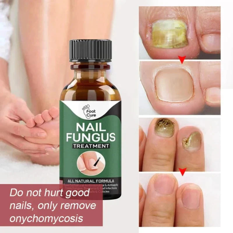 Nail Fungus Treatment Serum 10ml